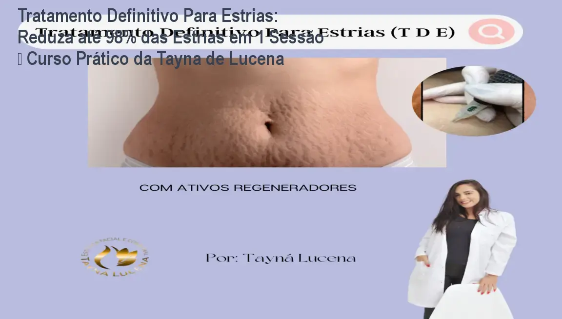 Tratamento Definitivo Para Estrias: Reduza até 98% das Estrias em 1 Sessão – Curso Prático da Tayna de Lucena 1 https://cursoss.com.br/tratamento-definitivo-estrias-curso-pratico-reduz-98/ Imagem do curso Tratamento Definitivo Para Estrias mostrando a técnica de permeabilização dérmica que reduz visivelmente estrias