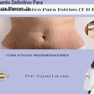 Curso Tratamento Definitivo Para Estrias – Reduza Marcas Já