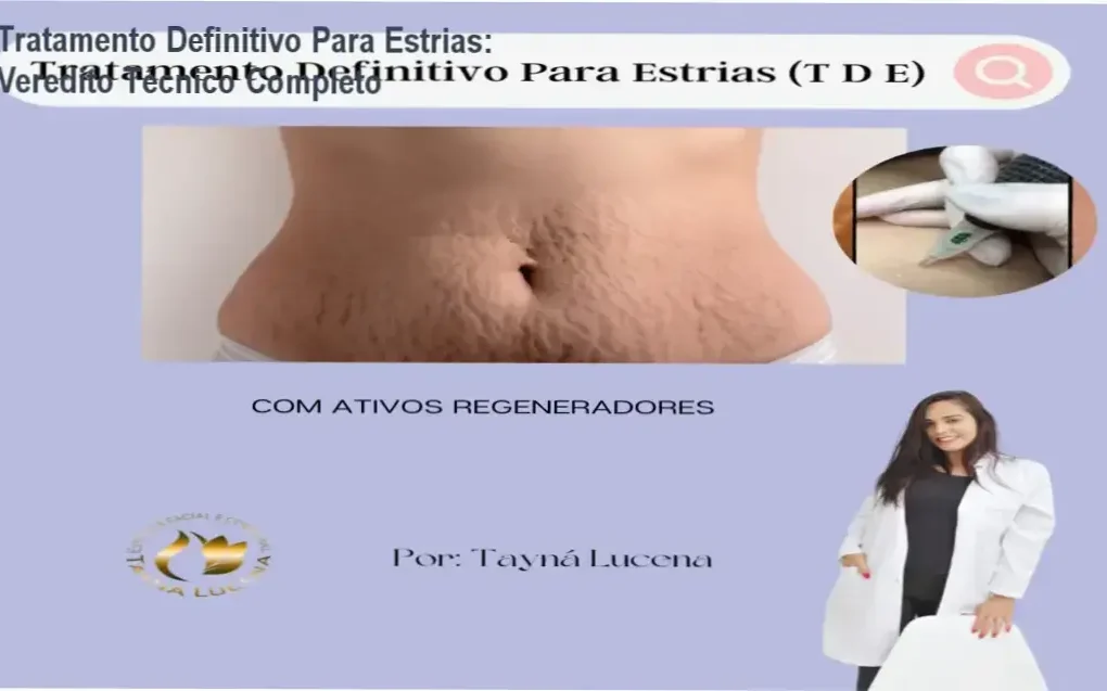 Aplicação do Método TDE para regeneração dérmica e redução de estrias