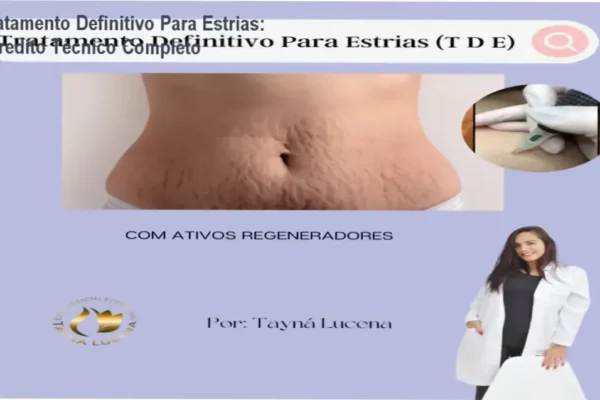 Tratamento Definitivo Para Estrias: Veredito Técnico Completo