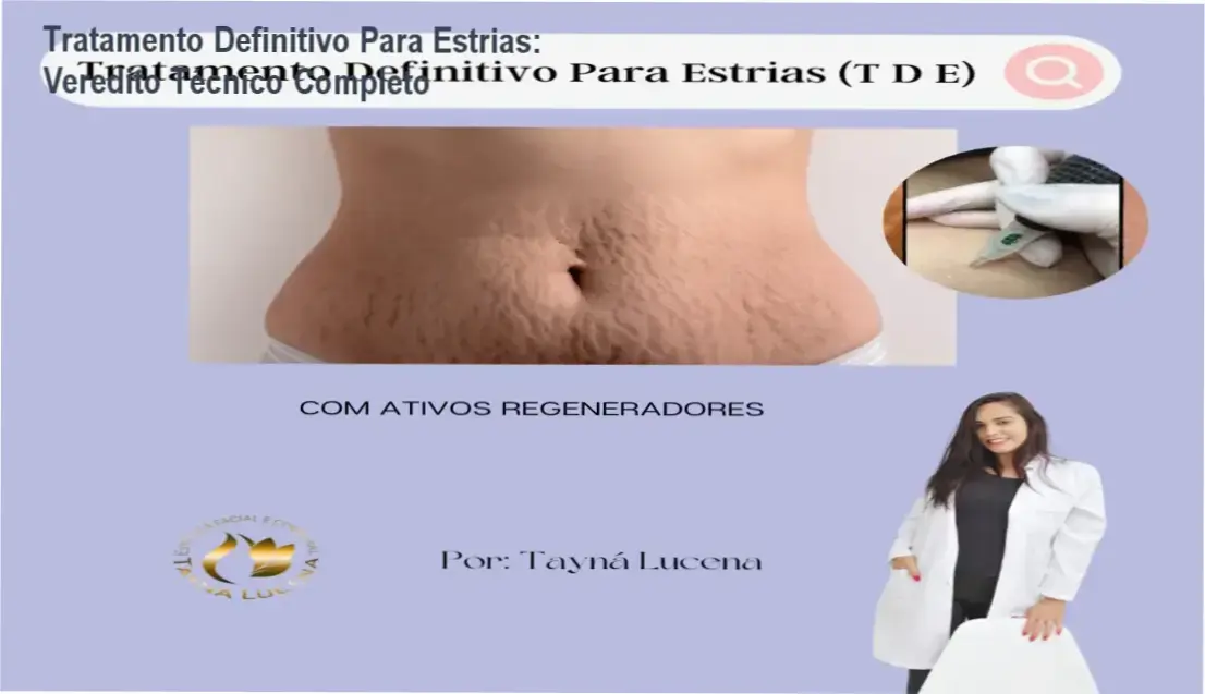 Aplicação do Método TDE para regeneração dérmica e redução de estrias